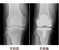 人工膝関節置換術について