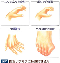 関節リウマチに特徴的な手・足の変形