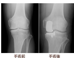 部分置換型人工膝関節